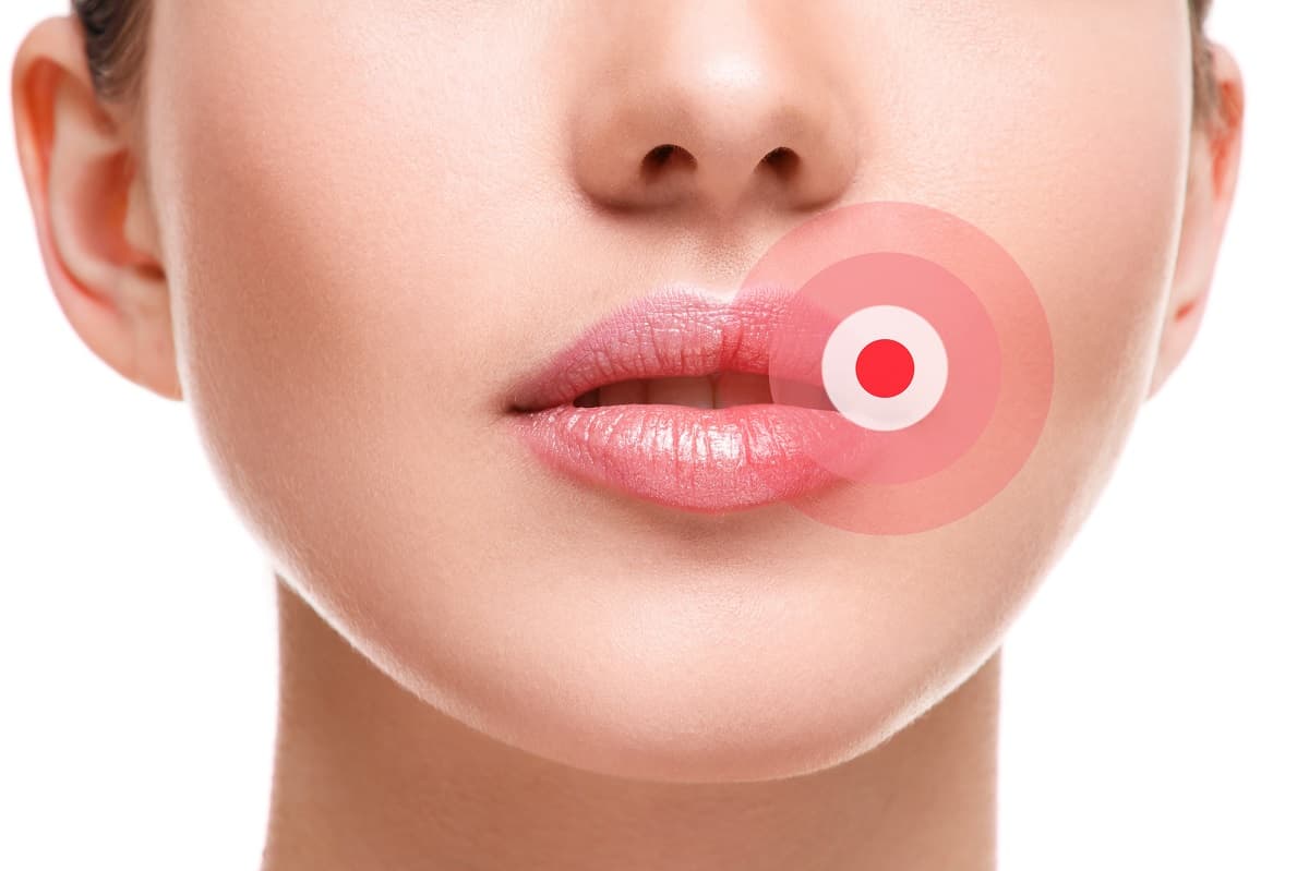 Herpes labial chica probioticos prokey